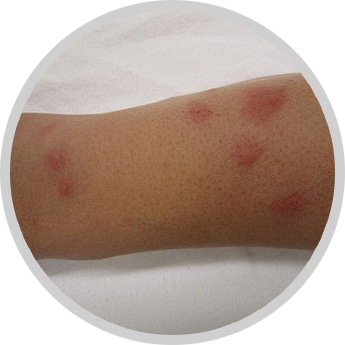 Bed bug bites in a line on skin